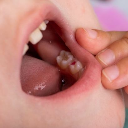 Close up of child's mouth with red spot on one tooth
