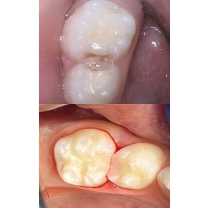 Teenage boy smiling after getting tooth colored fillings for cavity treatment for kids in Leesburg