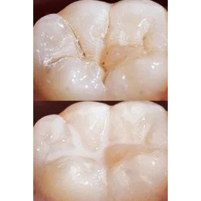 Close up of dental mirror showing reflection of teeth